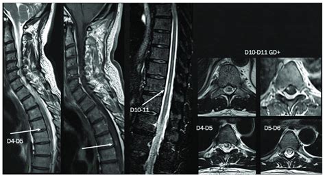 Brain MRI shows multiple T2-hyperintense lesions in both supra-and... | Download Scientific Diagram