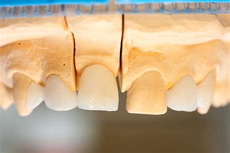 E-max Crowns - (Dis)Advantages, Costs, Procedure | Dental Treatment Guide