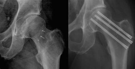 Femoral Neck Fracture - Symptoms, Treatment And Duration - Fitt Feast