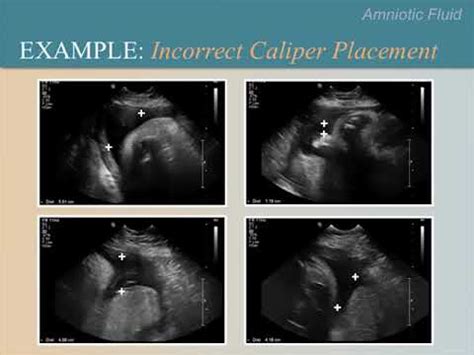 Amniotic Fluid Ultrasound