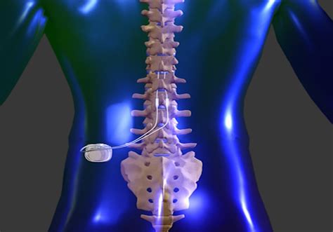 Stimulator for Back Pain Relief | Minimally Invasive | OrthoIndy