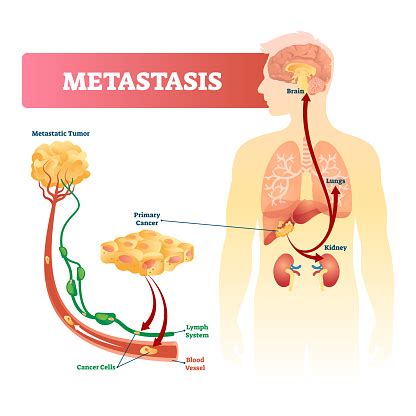 Metastasis Vector Illustration Primary Cancer And Tumor Labeled Diagram Stock Illustration ...