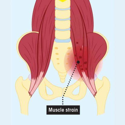 Everything you need to know about hip flexor strain - Women's Running