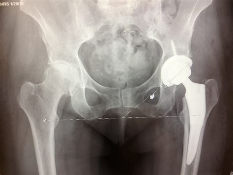 Anterior Hip Replacement Surgery: An Overview - OSMS - Orthopedic and Rheumatology Services in ...