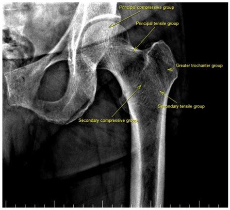 Osteoporosis