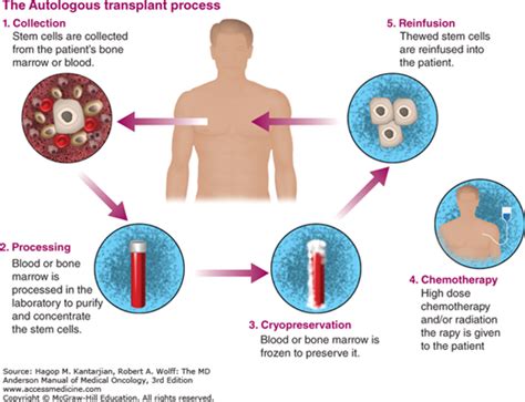 Autologous Bone Marrow Transplant