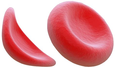 Sickle Cell Anemia Facts – A disease to be worried about? – Best Cookware