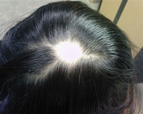 Genetic Basis of Alopecia Areata Established