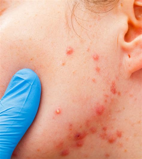 Acne In Children – Causes, Symptoms And Treatment