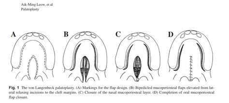 Cleft Lip and Cleft Palate Surgery - Elegant Plastic Surgical Ipoh ...