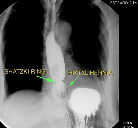 Schatzki ring causes, symptoms, diagnosis, treatment & prognosis