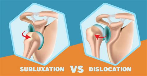 Shoulder Troubles? Breaking Down Subluxation vs. Dislocation