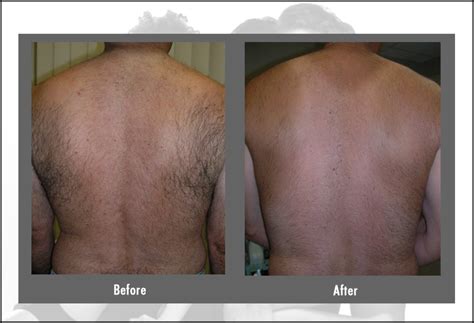 Laser Hair Removal | Cost, Before & After, FAQ | Hartford CTLaser Hair Removal | Cost, Before ...