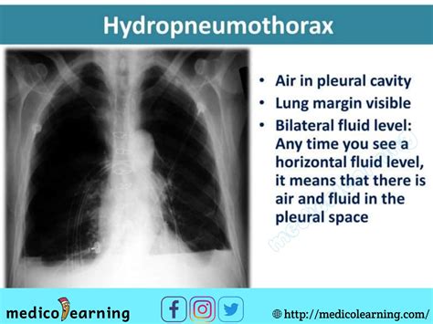 Hydropneumothorax | Medical radiography, Nursing school prerequisites, Medical mnemonics