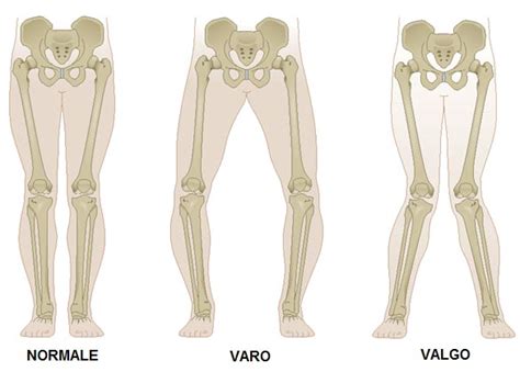 Ginocchio Varo-Valgo - Fisio Bregma