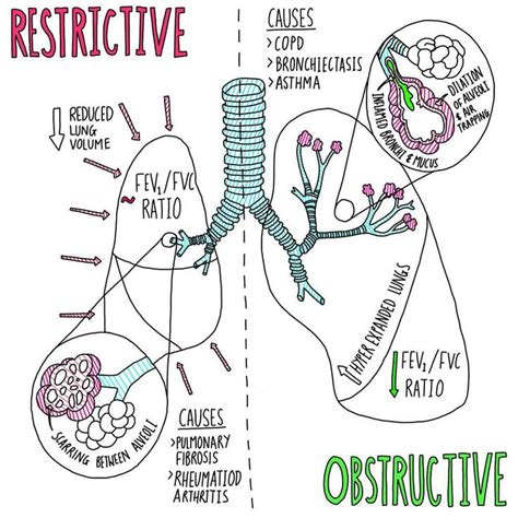 restrictive lung disease causes Restrictive lung diseases - Diseases ...