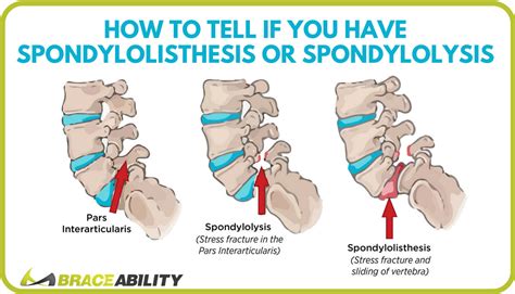 Spondylolisthesis Symptoms