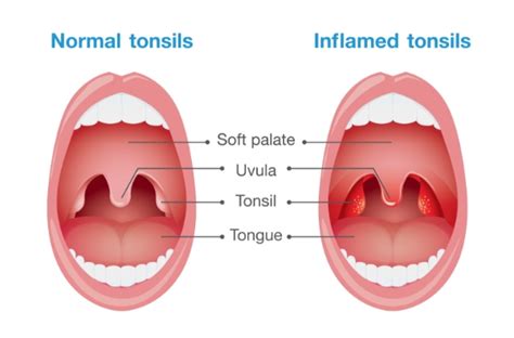 Chronic Sore Throat - Integrated ENT of Lone Tree, Colorado