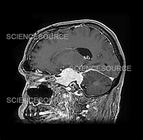 Photograph | Skull Base Meningioma 9 | Science Source Images