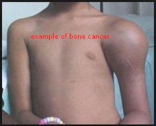 Causes Of Bone Cancer