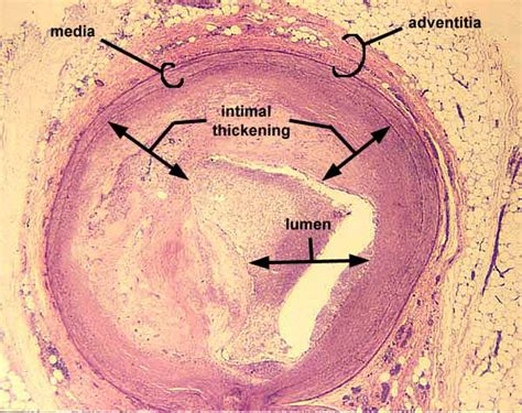 Memorandum: atherosclerosis- elastin stain