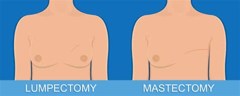 Mastectomy with Flat Closure Nightmare - Fitko Health