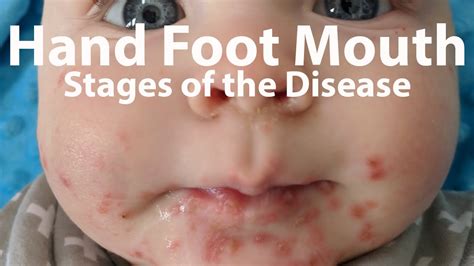 Foot And Mouth Disease - Atypical Hand Foot And Mouth Disease Associated With Coxsackievirus A6 ...