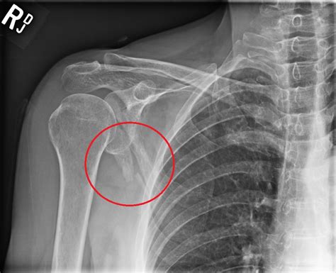 Scapula Anatomy Xray