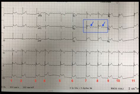 Dr. Smith's ECG Blog: Palpitations and Chest Tightness: Should You ...