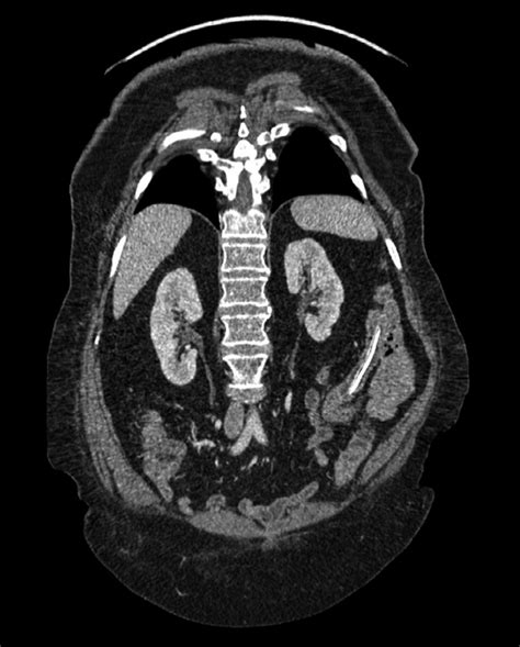 Tomografía de abdomen y pelvis, corte coronal. Se aprecia trayecto... | Download Scientific Diagram