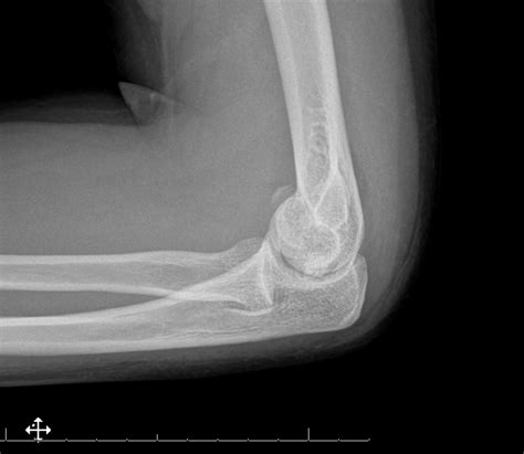 Distal Humerus Fractures - Trauma - Orthobullets