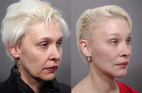 Mini Facelift Before & After - Dr. Andrew Jacono | Eye lift surgery, Face lift surgery, Mini ...