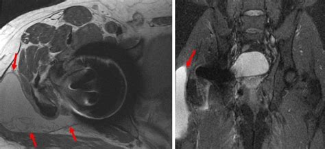 SurfaceHippy | MRI's After Hip Resurfacing | Imaging, Hip, Mri, Artifact