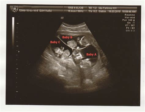 12 best Ultrasound Photos of Twins & Multiples images on Pinterest ...