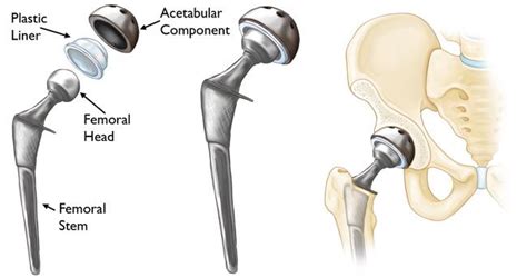 Minimally Invasive Total Hip Replacement - OrthoInfo - AAOS