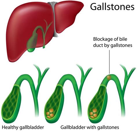 Gall Bladder Stone Symptoms