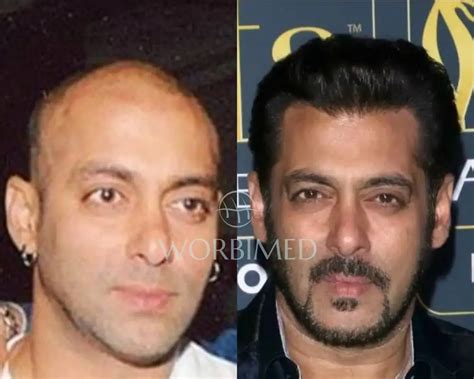 Salman Khan Hair Transplant l Before and After