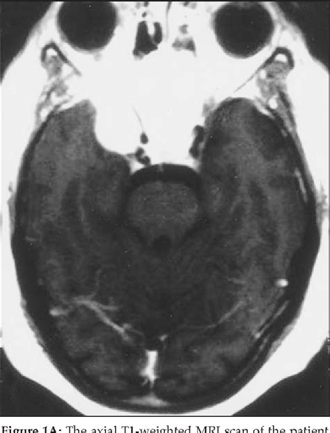 Figure 1 from Brain Metastasis From Follicular Thyroid Carcinoma : Case report and Literature ...