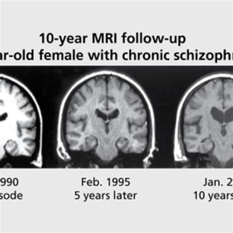 10-year brain MRI follow-up of a schizophrenia patient | Download ...