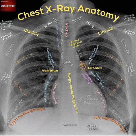 Time again to revise Chest X-Ray Anatomy! Swipe left to look through 8 ...