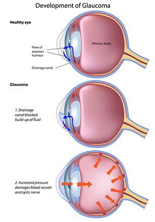 LPI (Laser Peripheral Iridotomy) Treats Narrow Angle Glaucoma - Eye ...