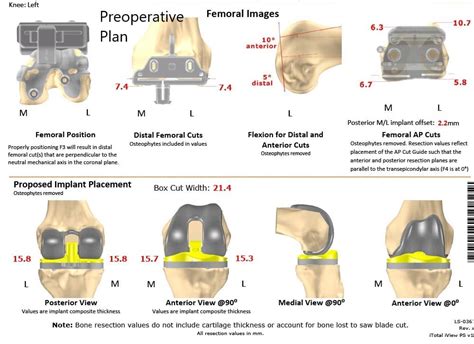 Case Study: Custom Total Left Knee Replacement in Arthritis