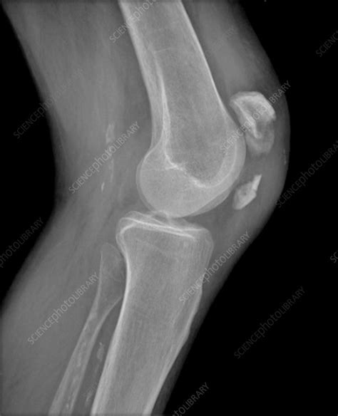 Knee cap fracture, X-ray - Stock Image - C014/7045 - Science Photo Library