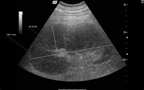 Ultrasound scan demonstrating enlarged kidney with thickened cortex ...