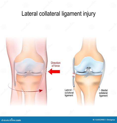 Fibular Collateral Ligament Injury. Joint Anatomy Stock Vector ...