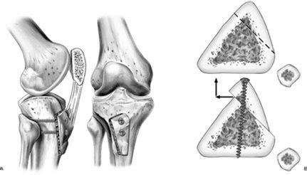 Tibial Tubercle Osteotomy - Sydney Knee Specialists