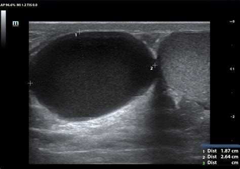 Testicular Cyst Ultrasound