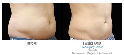 CoolSculpting Abdomen / Stomach Before and After Photos NYC