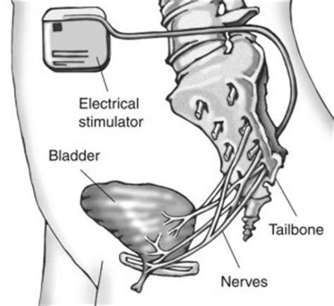 Sacral Nerve Stimulation for Incontinence