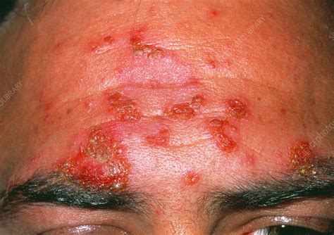 Impetigo skin infection - Stock Image - M180/0098 - Science Photo Library